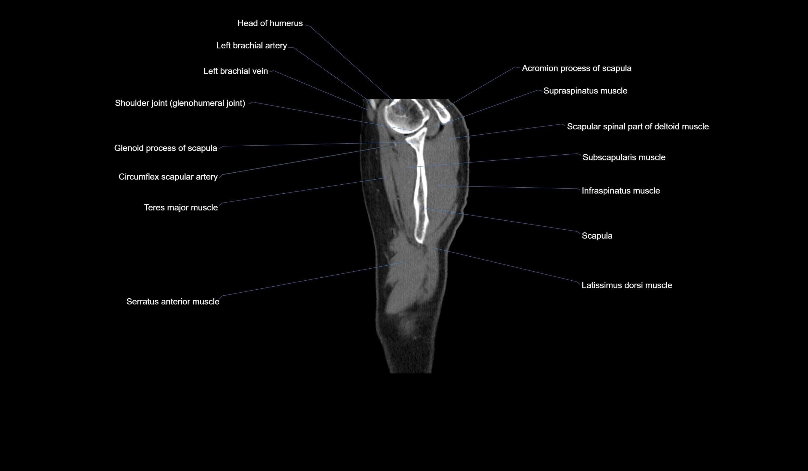 CT chest (thorax) soft tissue window labelled sagittal cross sectional anatomy radiology image-00137.webp